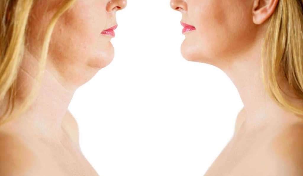 Double Chin treatment Houghton Regis before and after results
