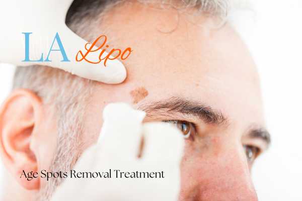 What Are the Most Effective Treatments for Age Spots Houghton Regis?