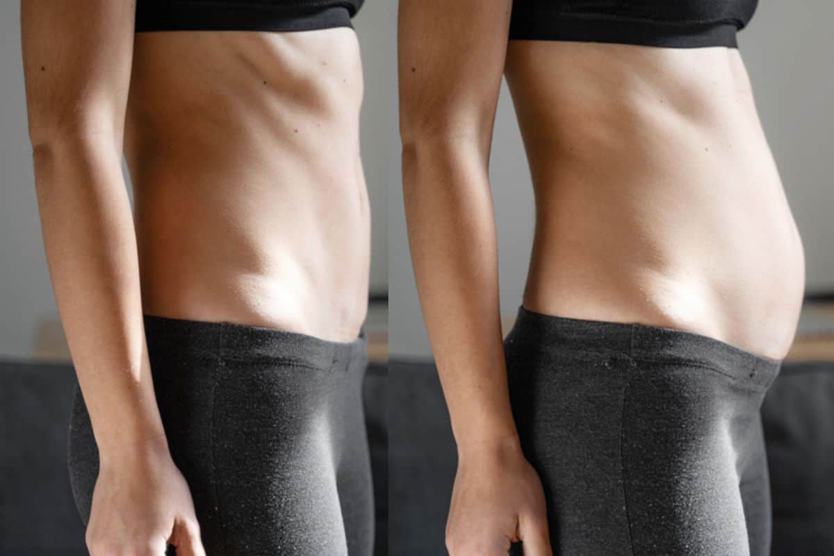 How long does diastasis recti take to improve Houghton Regis?