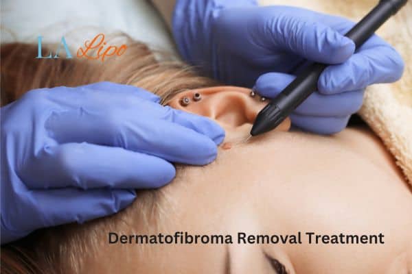 Dermatofibroma Removal Treatment Houghton Regis