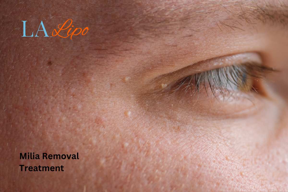 Cryopen Milia Removal: Is It the Easiest and Safest Option Houghton Regis?