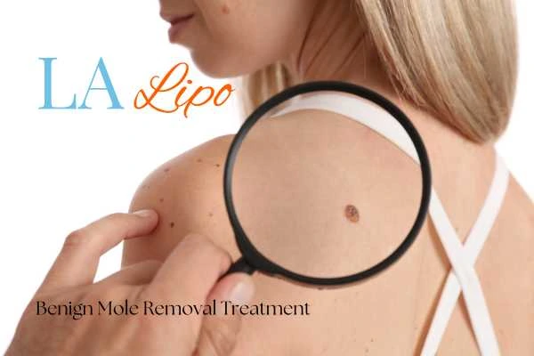 Why getting moles removed Houghton Regis can boost your confidence!