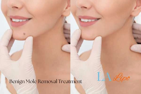 Woman's before and after results of being moles removal treatment Houghton Regis