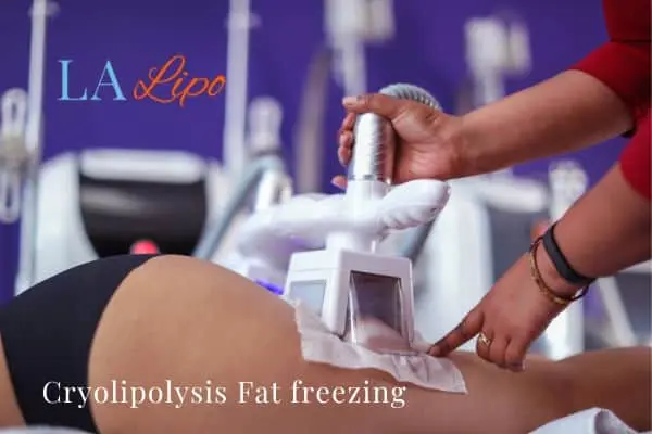 women getting fat freezing Houghton Regis