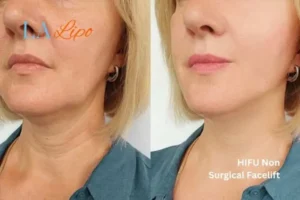 hi-fu for wrinkles Houghton Regis before and after results