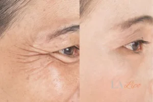 Before and after results of woman - HI-fu wrinkles reduction treatment Houghton Regis