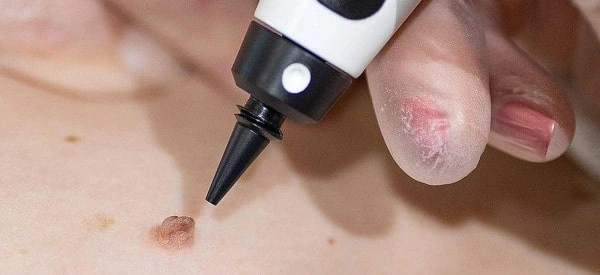 skin tag removal using cryopen Houghton Regis
