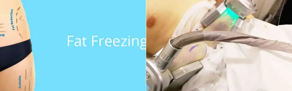 multi areas of a persons body having coolsculpting Houghton Regis treatment