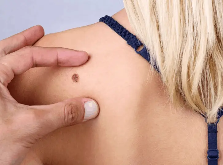 woman having mole removal Houghton Regis consultation before treatment.