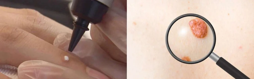 Person getting moles removed with cryopen Houghton Regis
