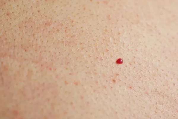 close up of a cherry angioma Houghton Regis