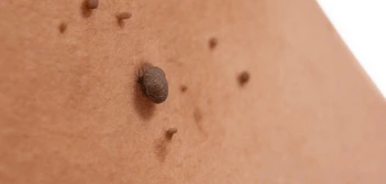 image of a skin tag Houghton Regis