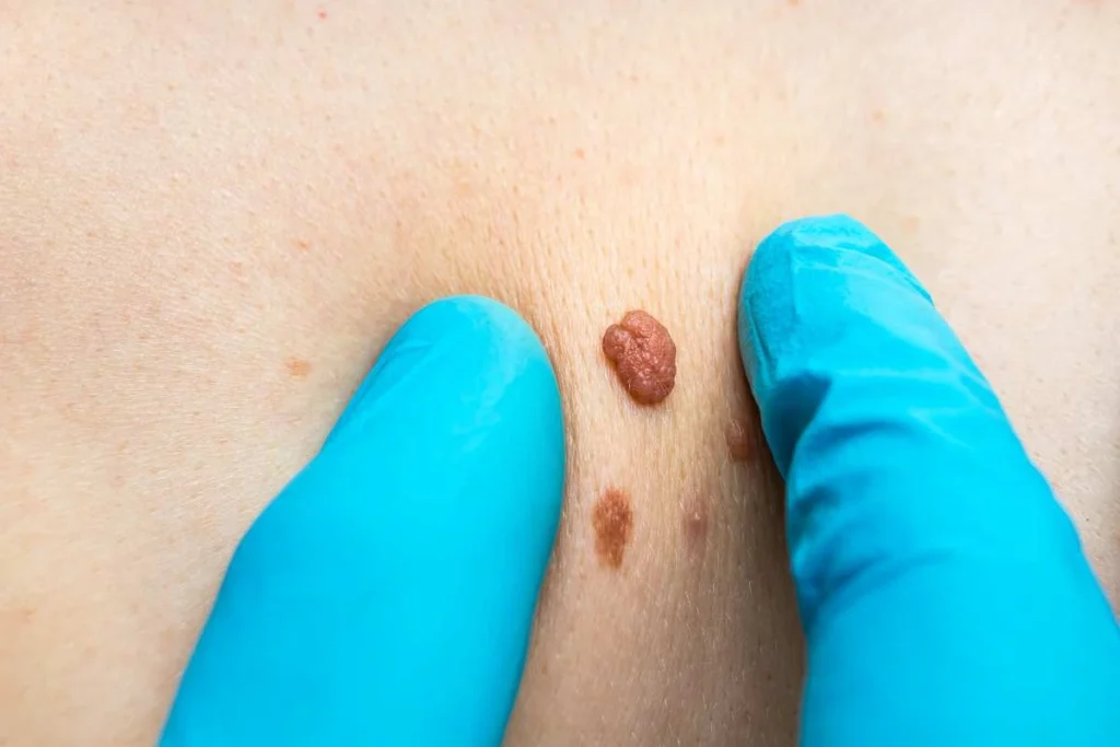 Consultant examining a skin tag Houghton Regis