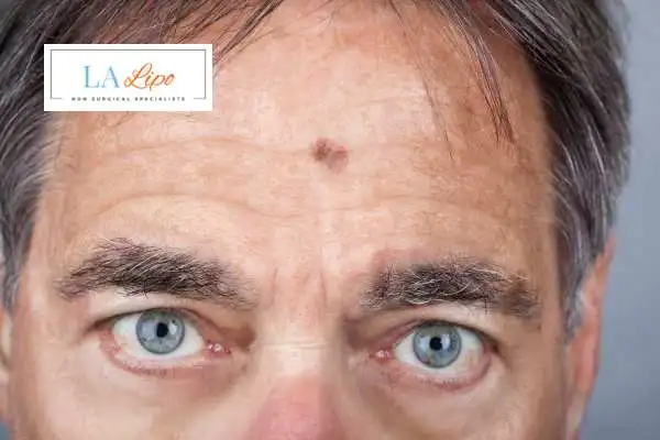 Solar Lentigo Removal Houghton Regis image of man with mark on his forehead