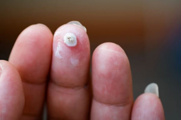 wart on person finger - cryotherapy to treat from LA LIPO Houghton Regis