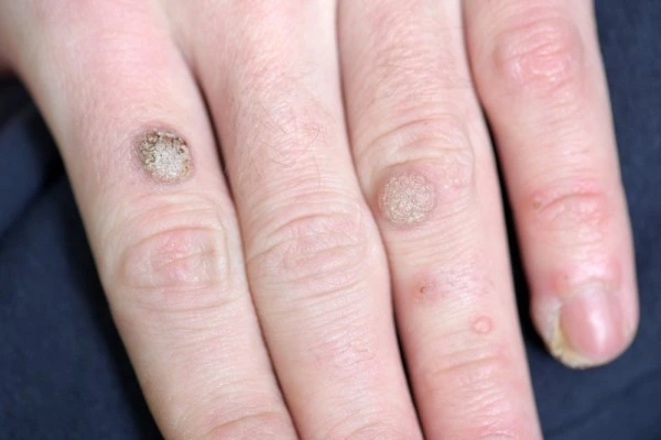 photo of warts on person hand - see wart removal Houghton Regis from LA LIPO