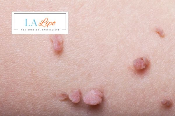 Does cryopen skin tag removal Houghton Regis hurt? Find out now call our team today!