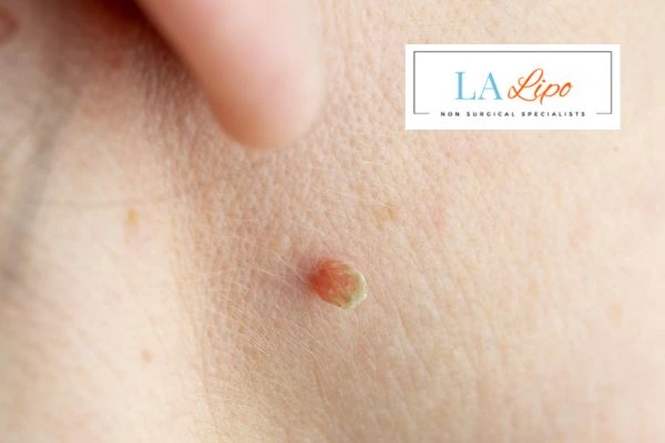 Book skin tag removal Houghton Regis today speak to our team now!