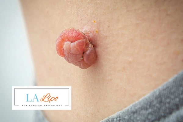 Interested in skin tag removal Houghton Regis? Concerned about the pain? Find out more today!