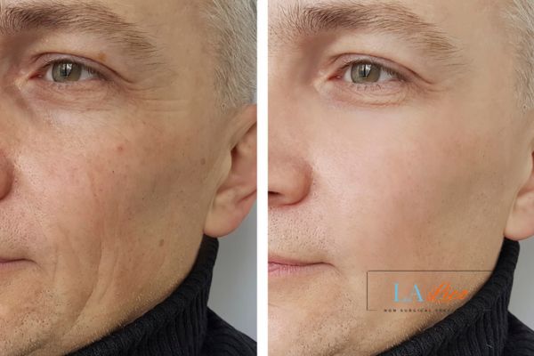 See the amazing results of Morpheus8 Treatment Houghton Regis!