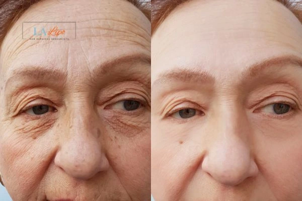 The powerful benefits of Morpheus8 Treatment Houghton Regis - Call Our team today!
