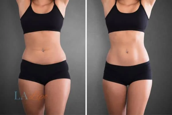 before and after results of non-surgical treatment to help a woman's body image and mental health Houghton Regis