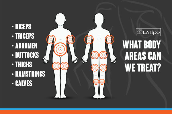 Diagram to show areas you can have LA-EMS Body Sculpting Treatment Houghton Regis