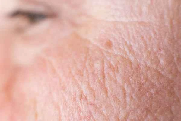 close up picture of a woman's face showing an age spot Houghton Regis