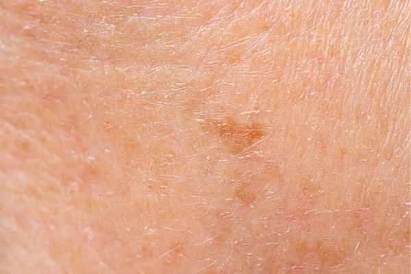 close up picture of age spots Houghton Regis