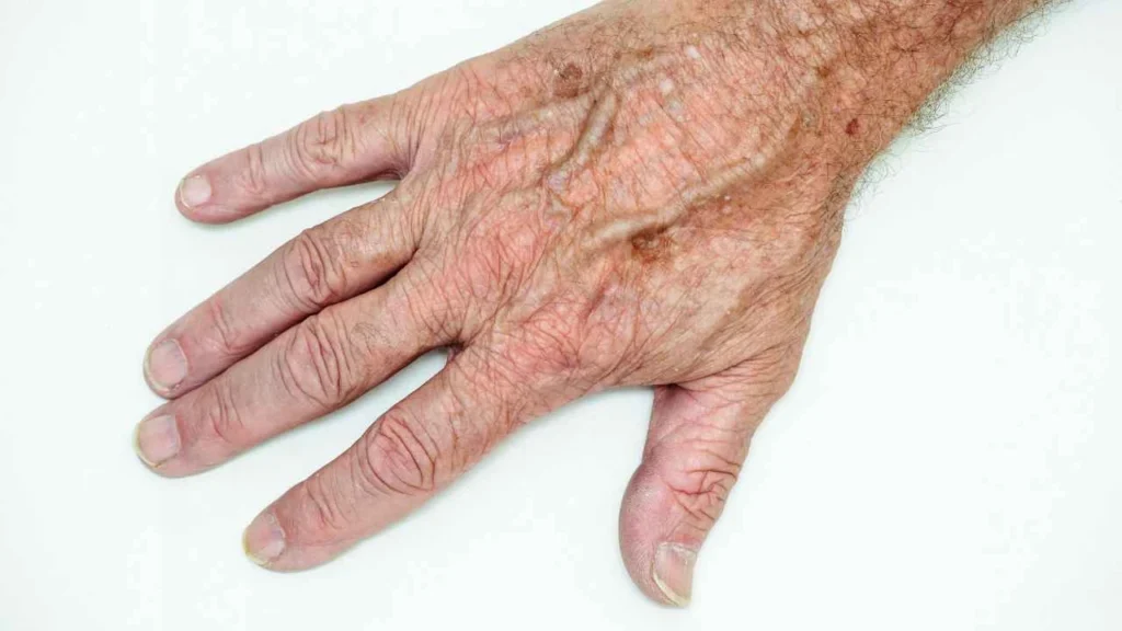 Male hand showing age spot Houghton Regis