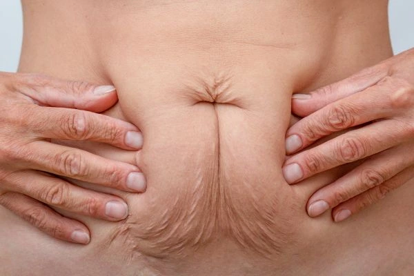 Image of a woman's stomach with loose skin - example of skin tightening Houghton Regis options