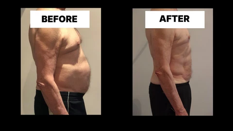 What Symptoms Can Diastasis Recti Cause in Men? Weak Core, Back Pain and Poor Posture Houghton Regis